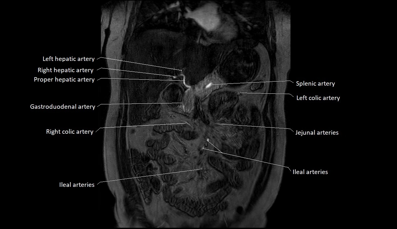 MRA Abdomen coronal anatomy image 1.webp